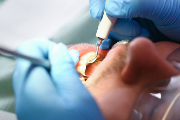Best Emergency Root Canal Treatment in Moscow, ID