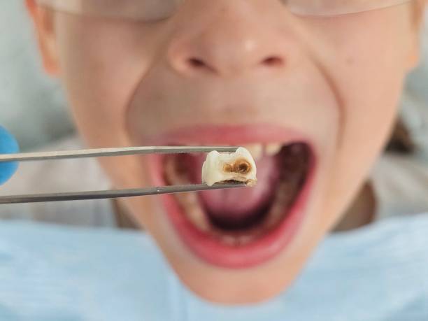 Best Emergency Treatment for Dental Infections or Abscesses in Moscow, ID